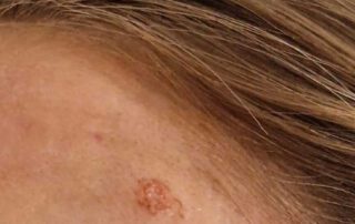 Tratament Laser CO2