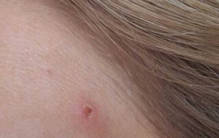 Tratament Laser CO2